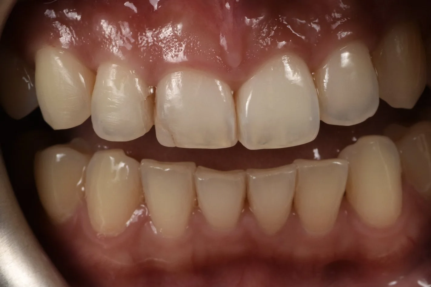 Dental Bonding before treatment
