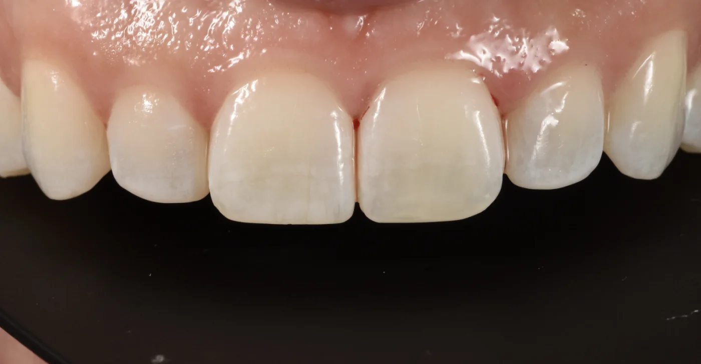 Dental Bonding after treatment