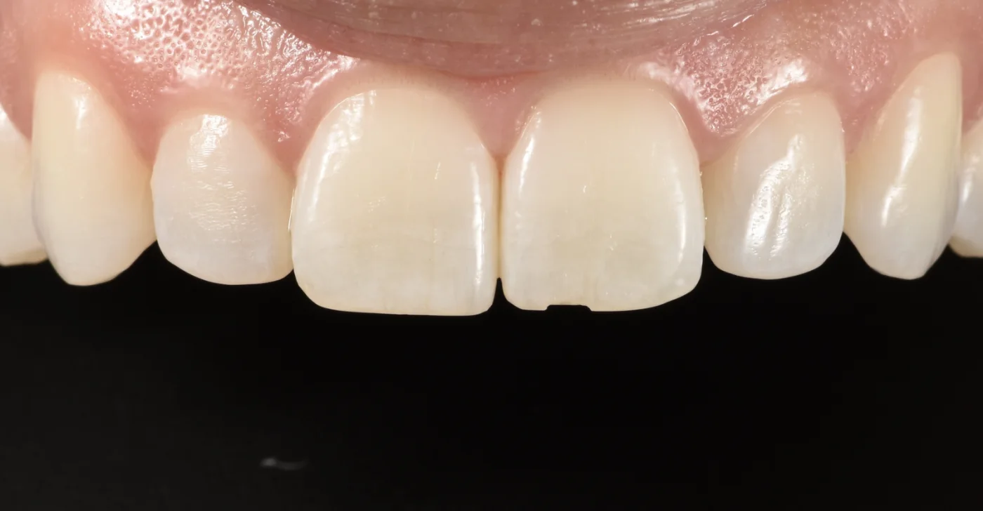 Dental Bonding before treatment