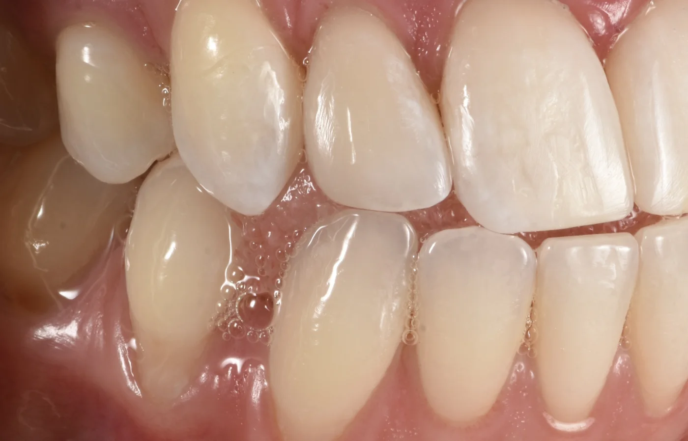 Dental Bonding after treatment