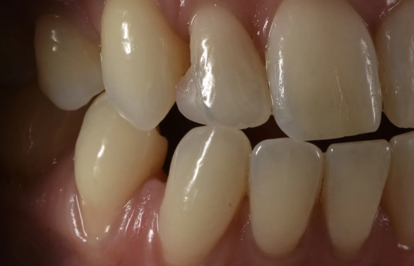 Dental Bonding before treatment