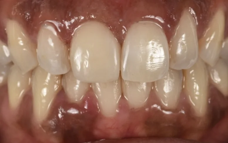 Dental Bonding after treatment