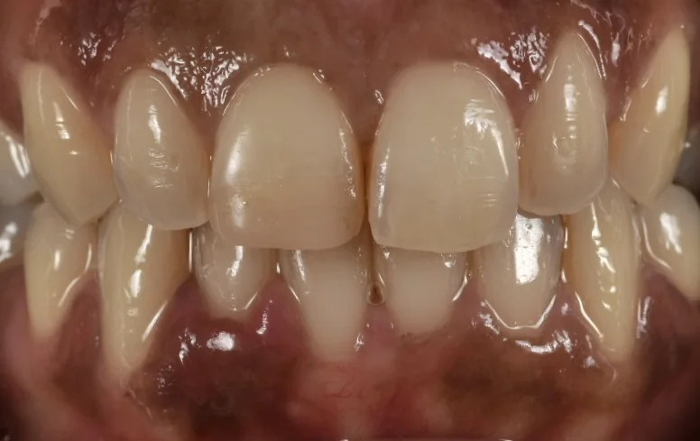 Dental Bonding before treatment