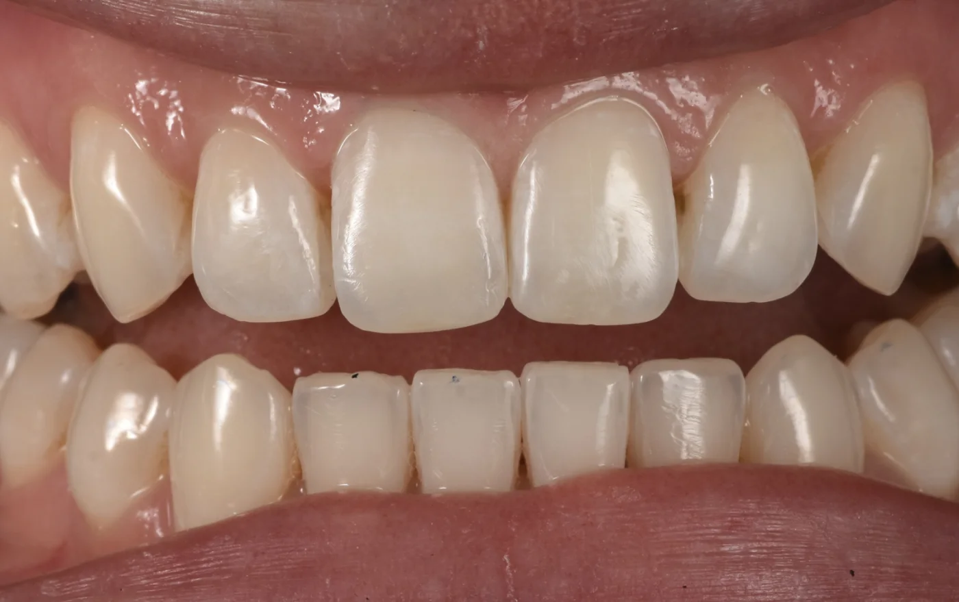 Dental Bonding after treatment
