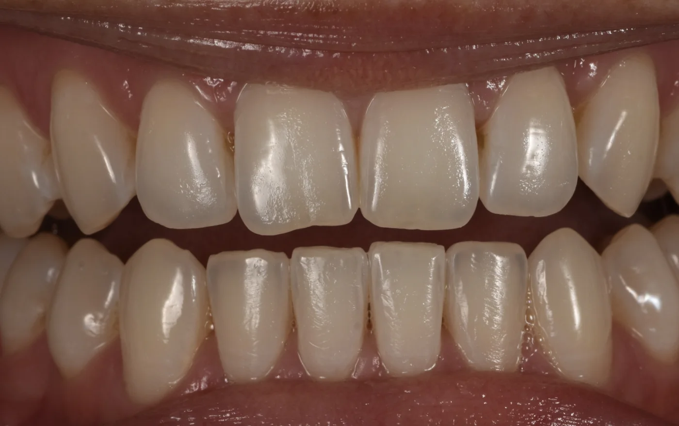 Dental Bonding before treatment