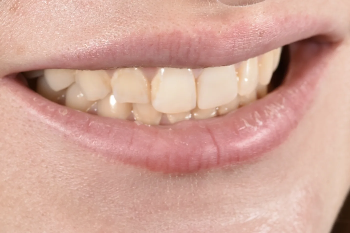 Dental Bonding after treatment