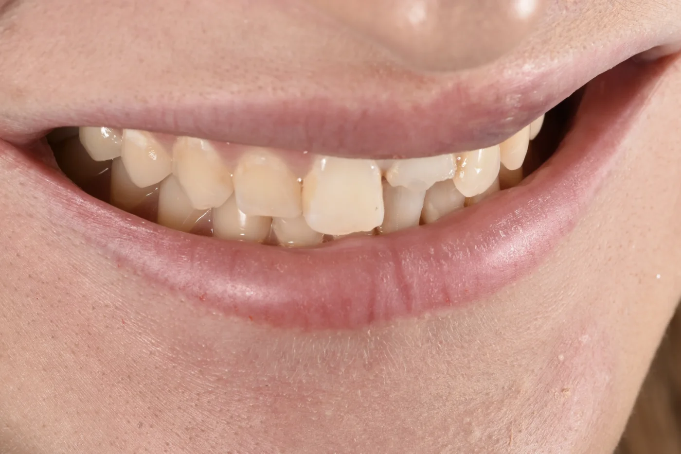 Dental Bonding before treatment