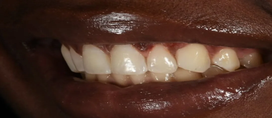 Dental Bonding after treatment