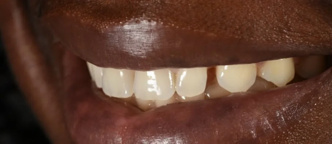 Dental Bonding before treatment