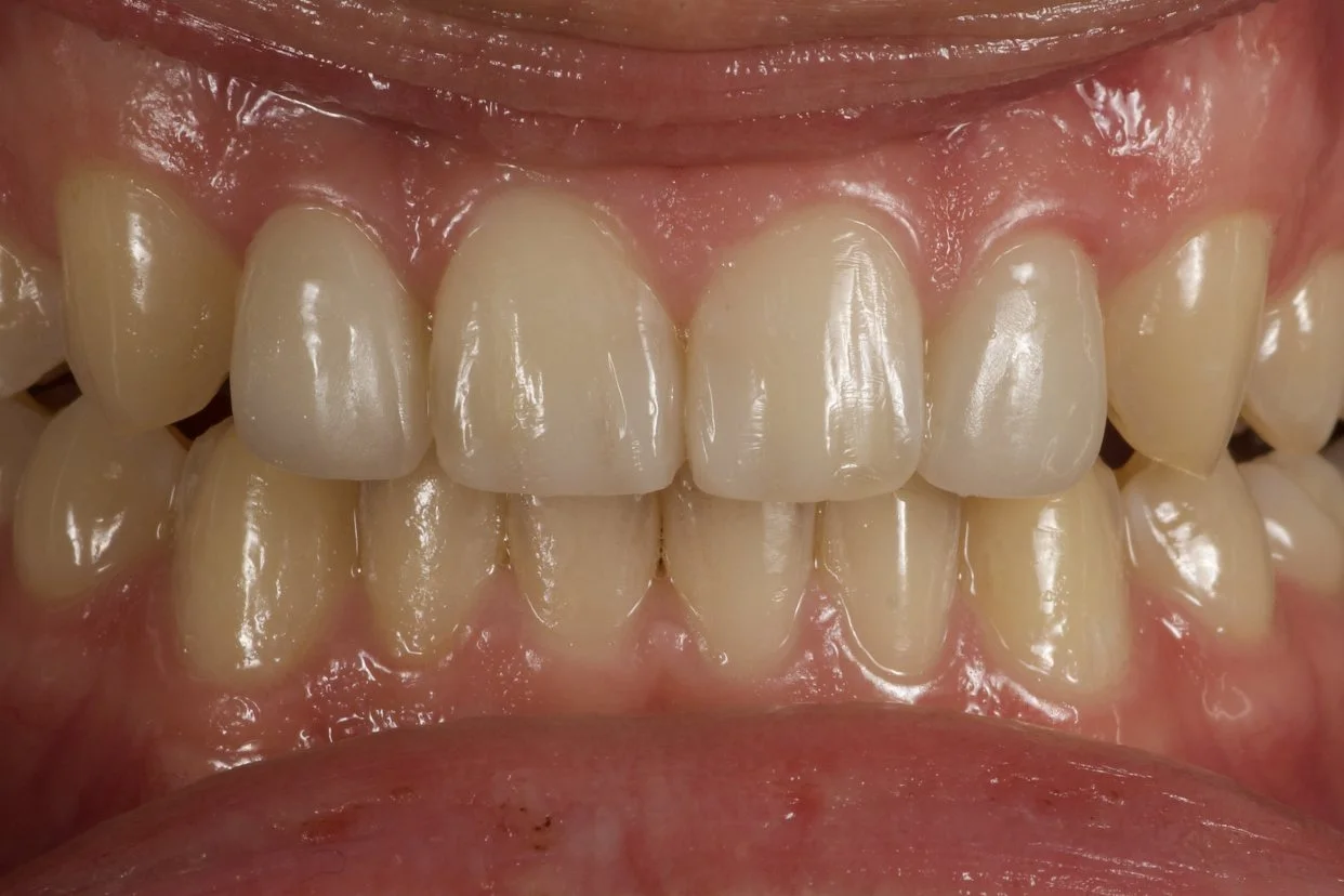 Dental Bonding after treatment