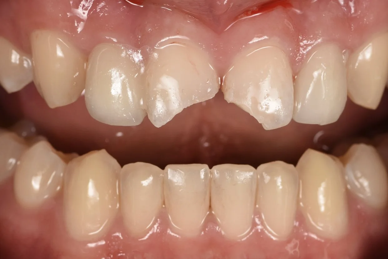 Dental Bonding before treatment