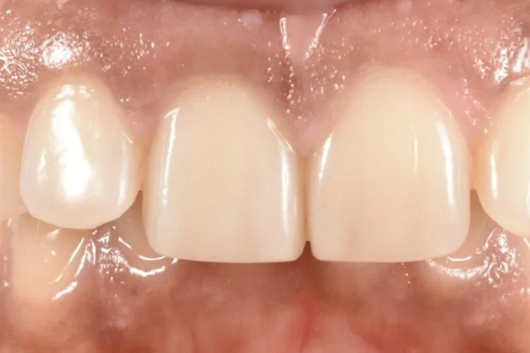 Dental Bonding after treatment