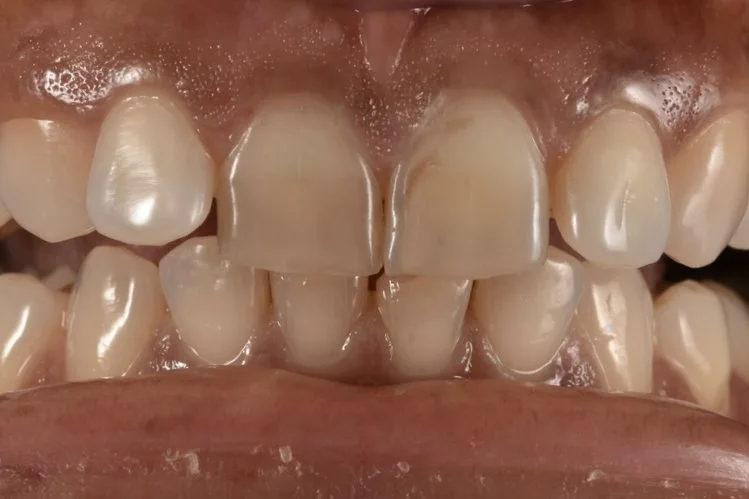 Dental Bonding before treatment