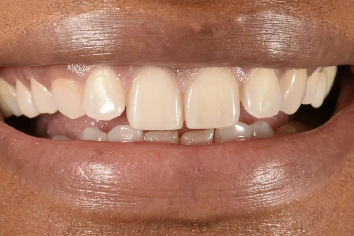 Dental Bonding after treatment