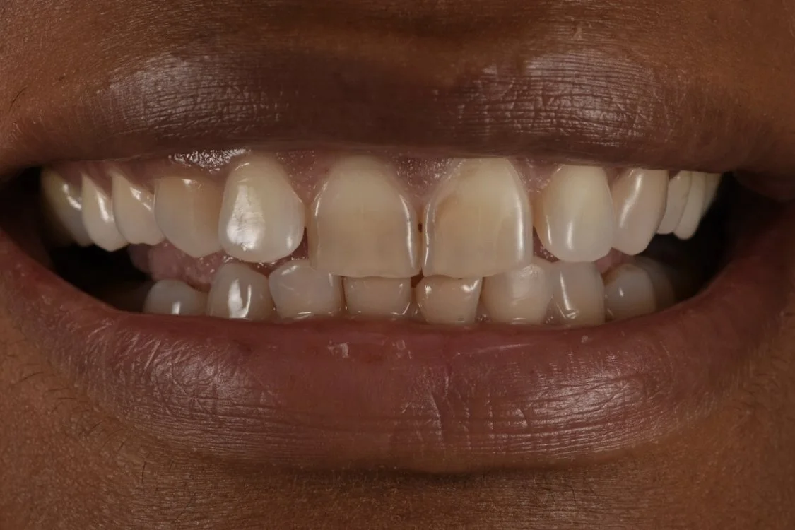 Dental Bonding before treatment