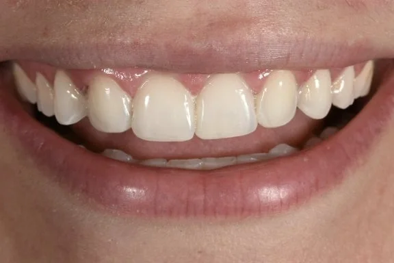 Dental Bonding after treatment