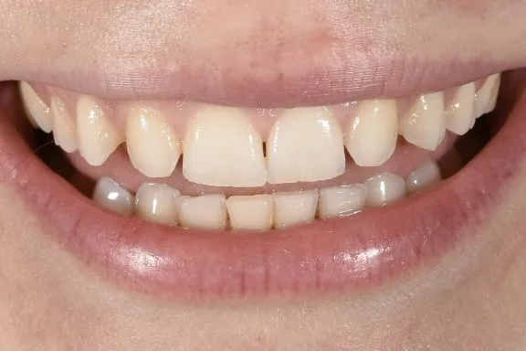 Dental Bonding before treatment