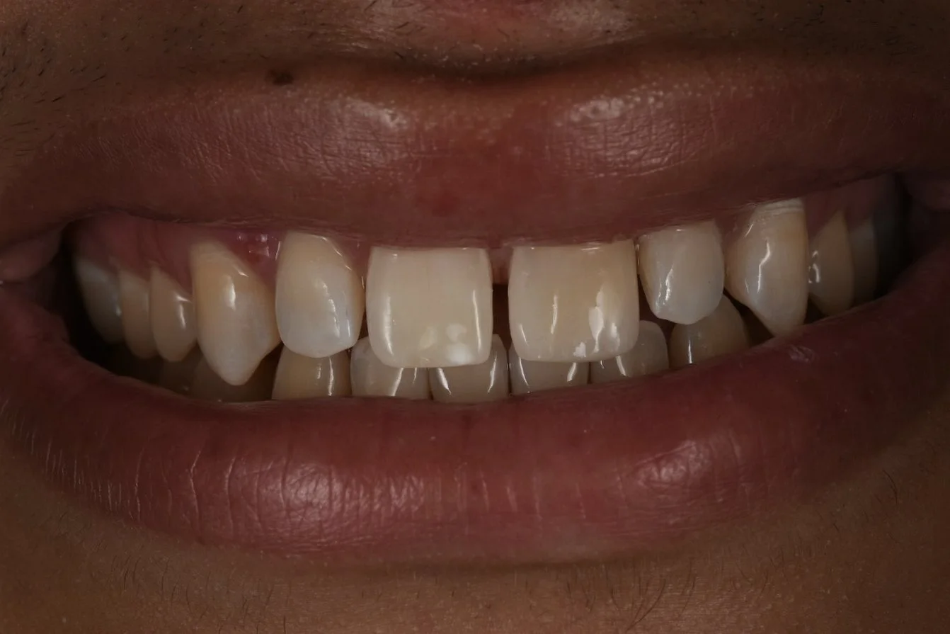 Dental Bonding after treatment