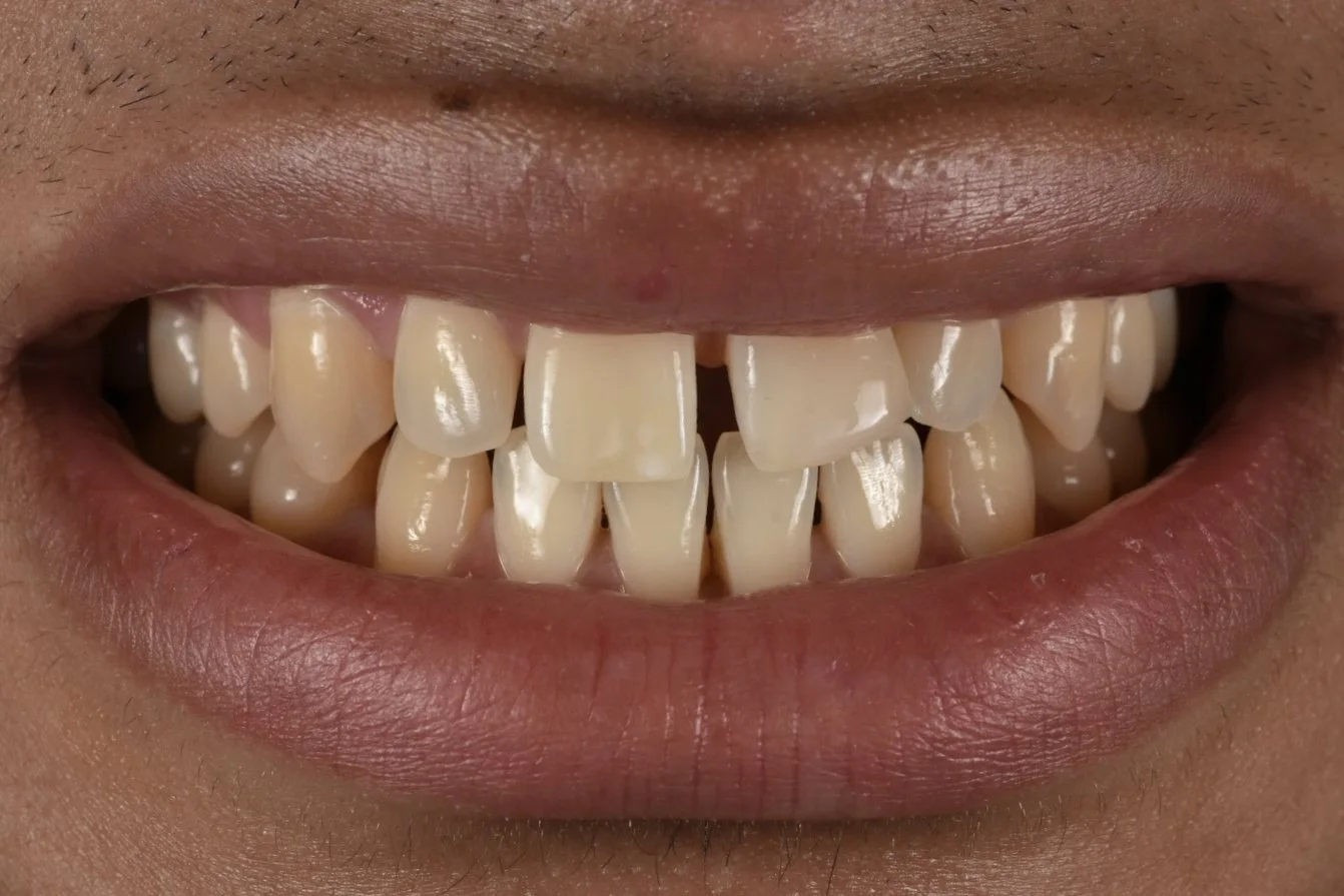 Dental Bonding before treatment