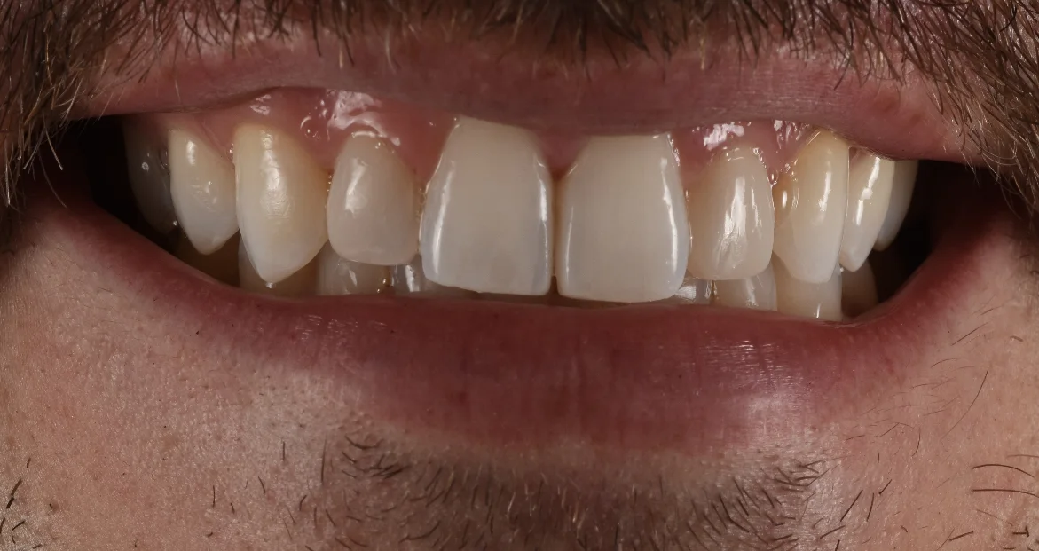 Dental Bonding after treatment