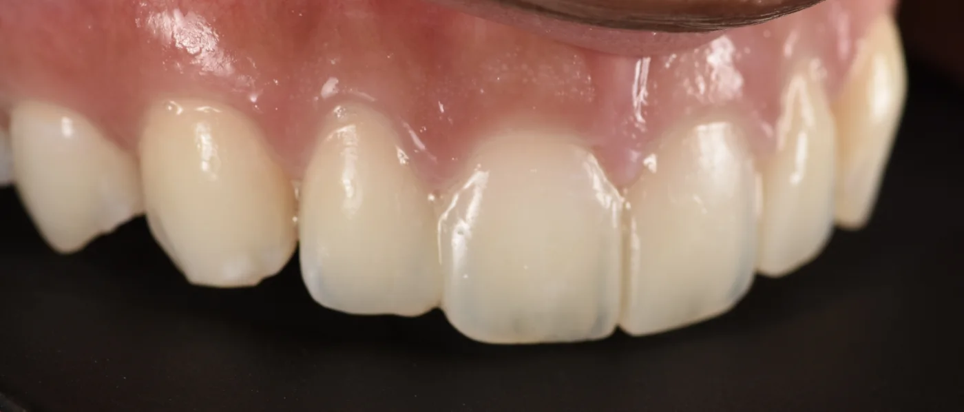 Dental Bonding after treatment