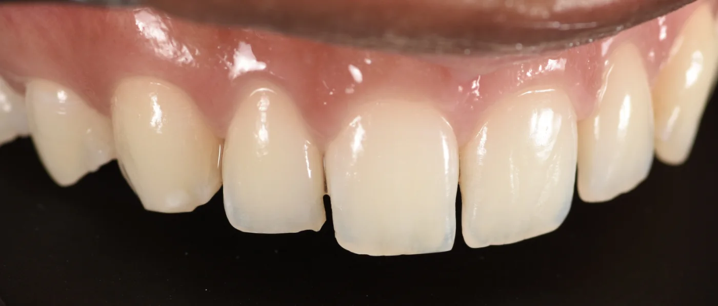 Dental Bonding before treatment