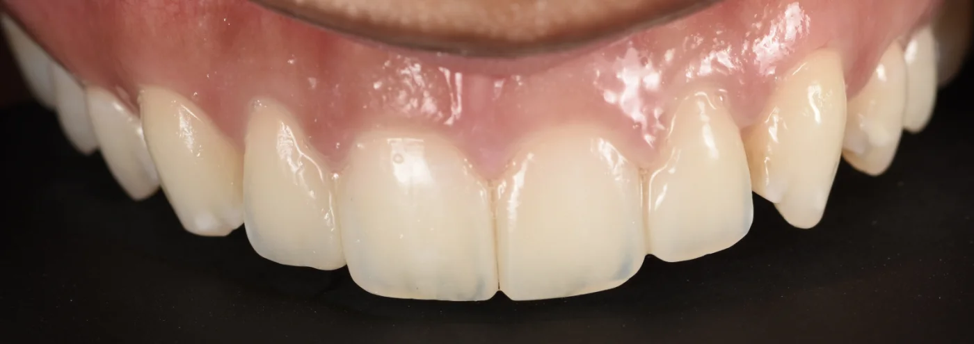 Dental Bonding after treatment