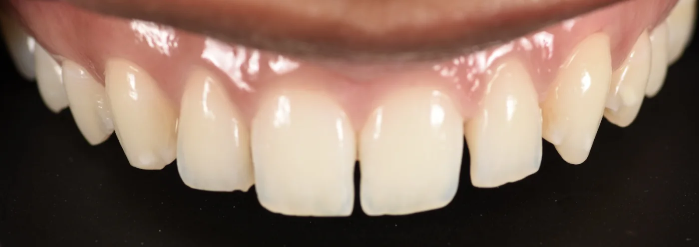 Dental Bonding before treatment
