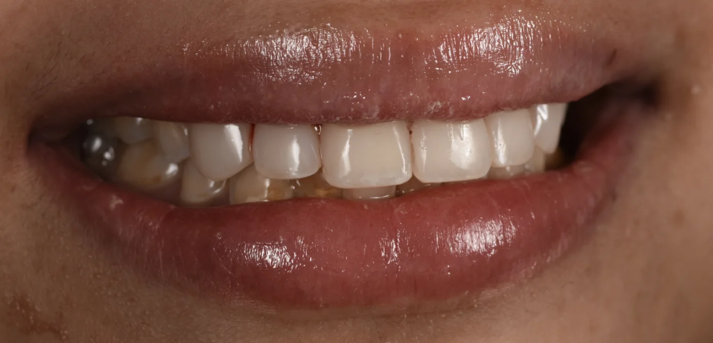 Dental Bonding after treatment