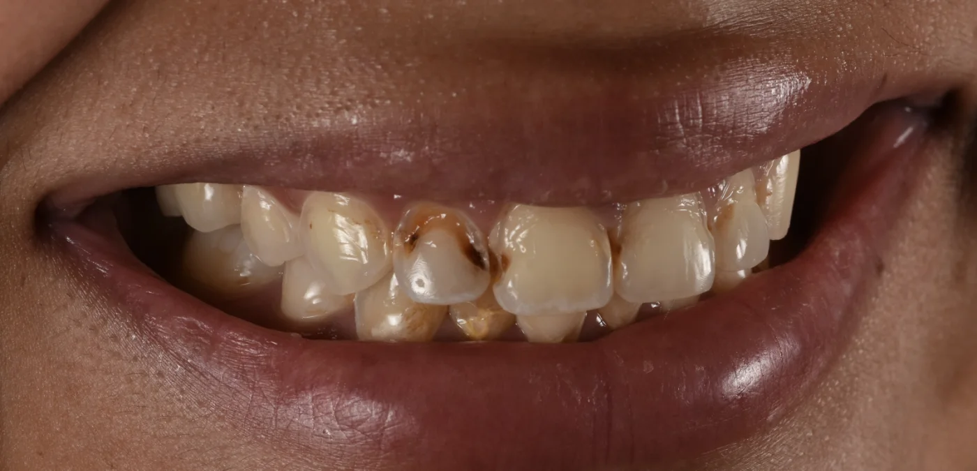 Dental Bonding before treatment