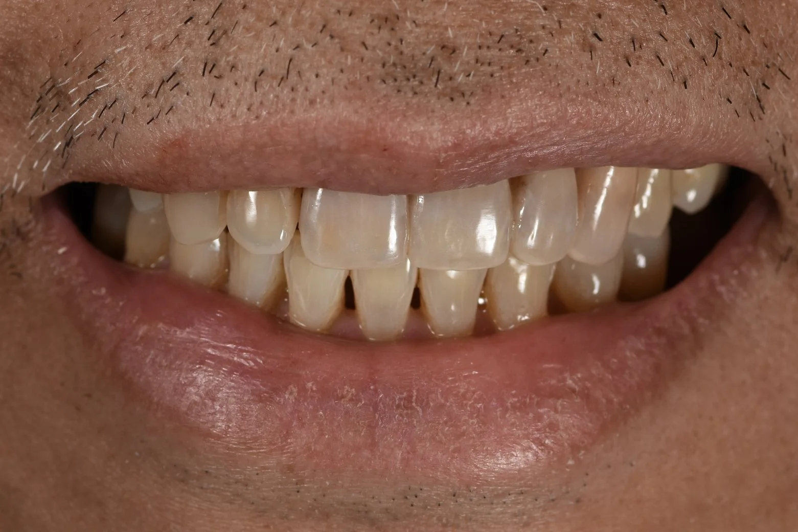 Dental Implant after treatment