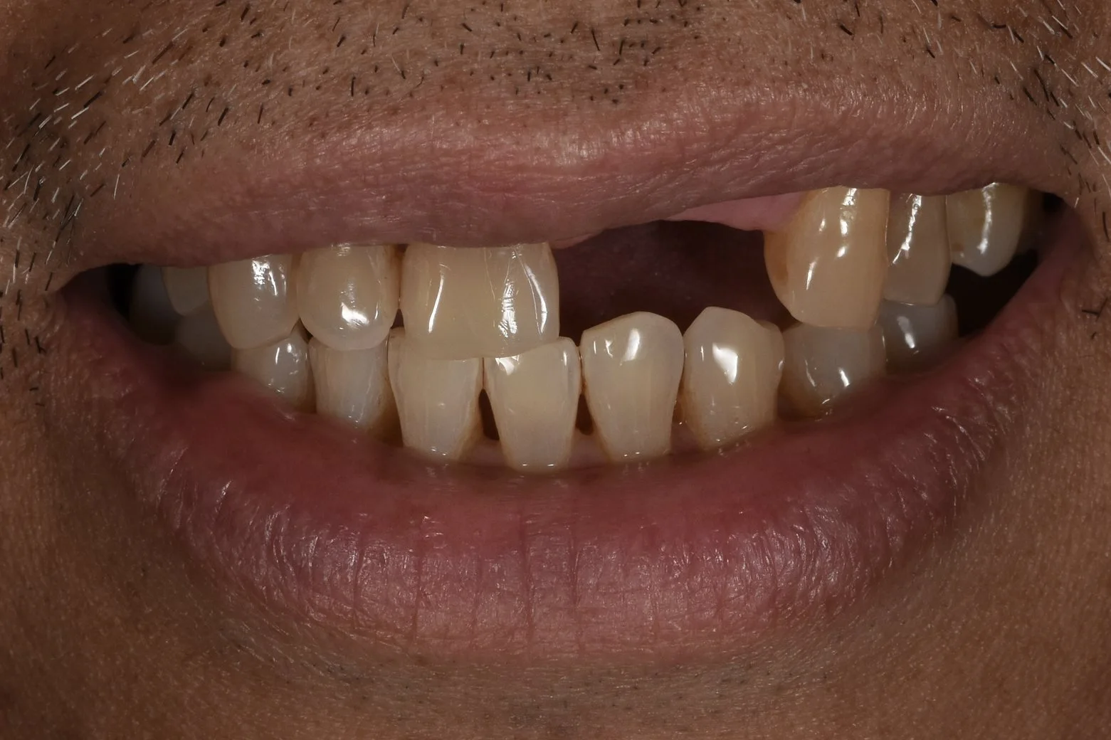 Dental Implant before treatment
