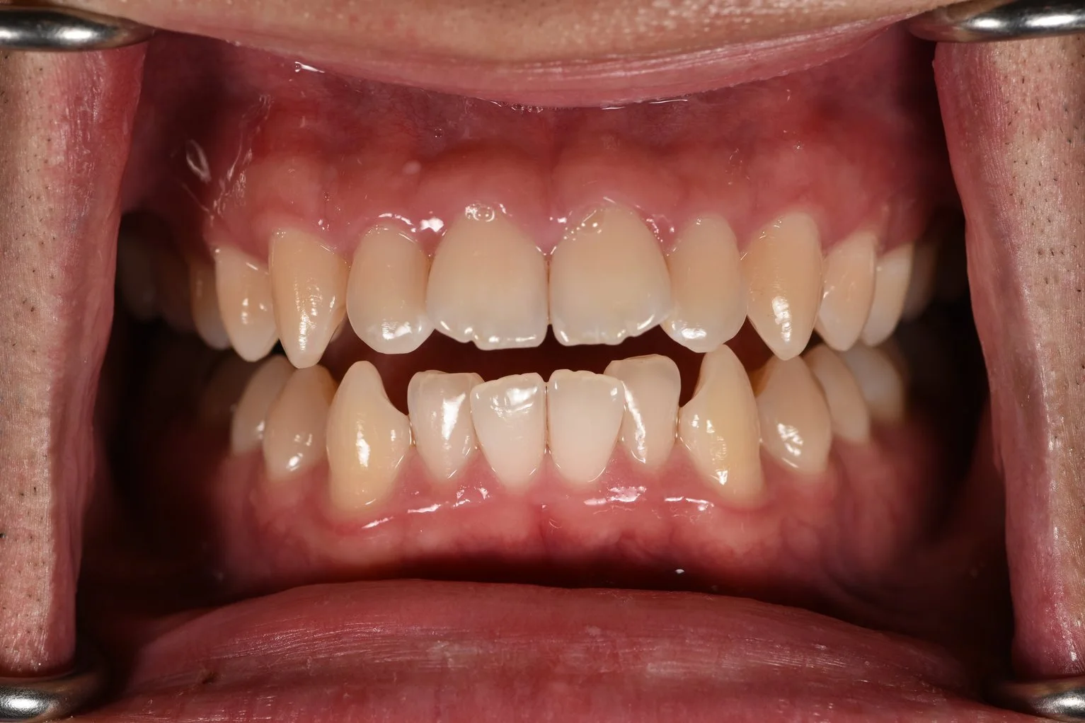 Invisalign before treatment