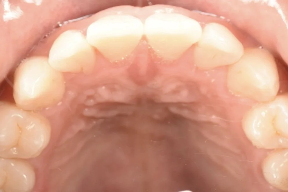 Invisalign after treatment