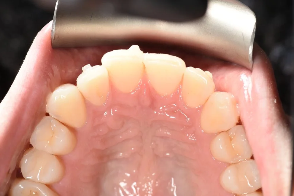 Invisalign before treatment