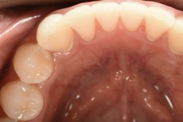 Invisalign after treatment