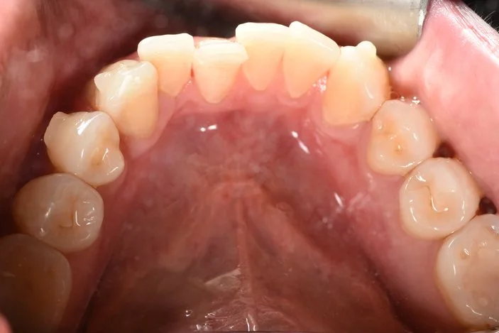 Invisalign before treatment