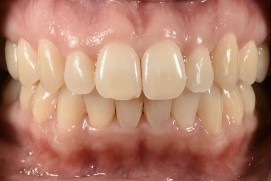 Invisalign after treatment