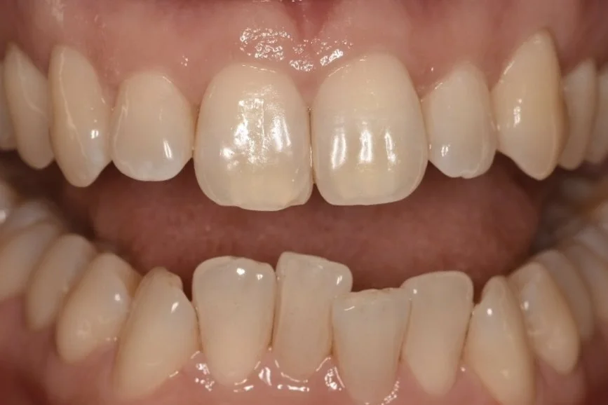 Invisalign before treatment