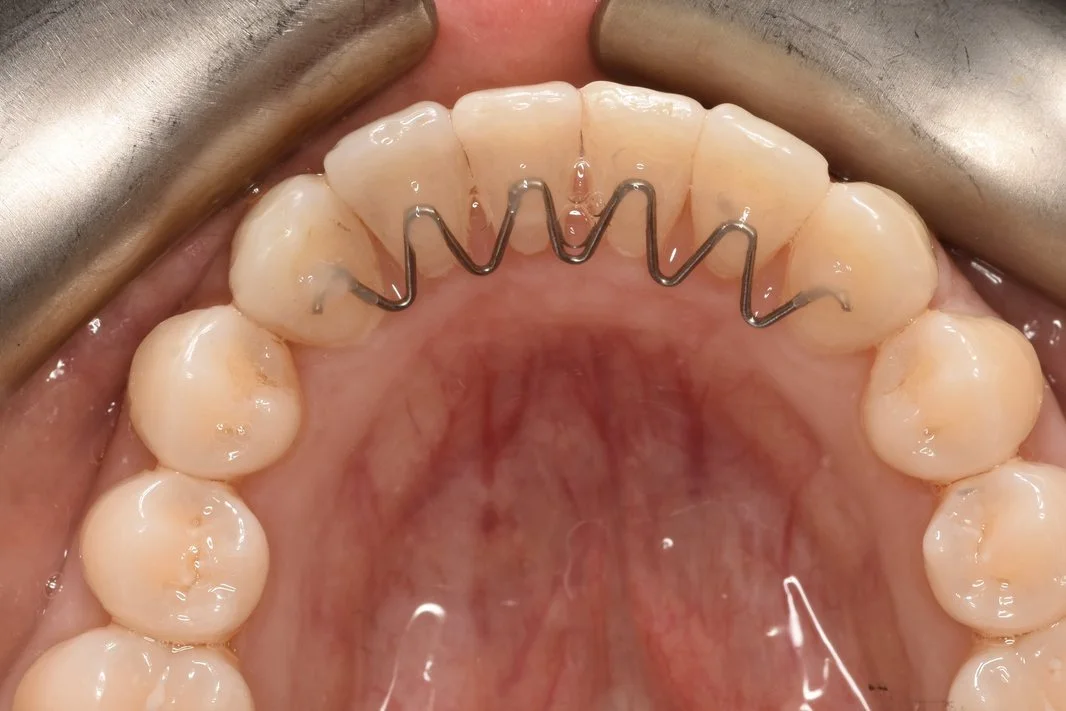 Invisalign after treatment