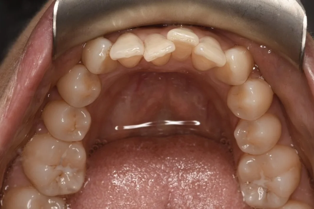Invisalign before treatment