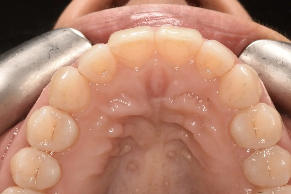 Invisalign after treatment