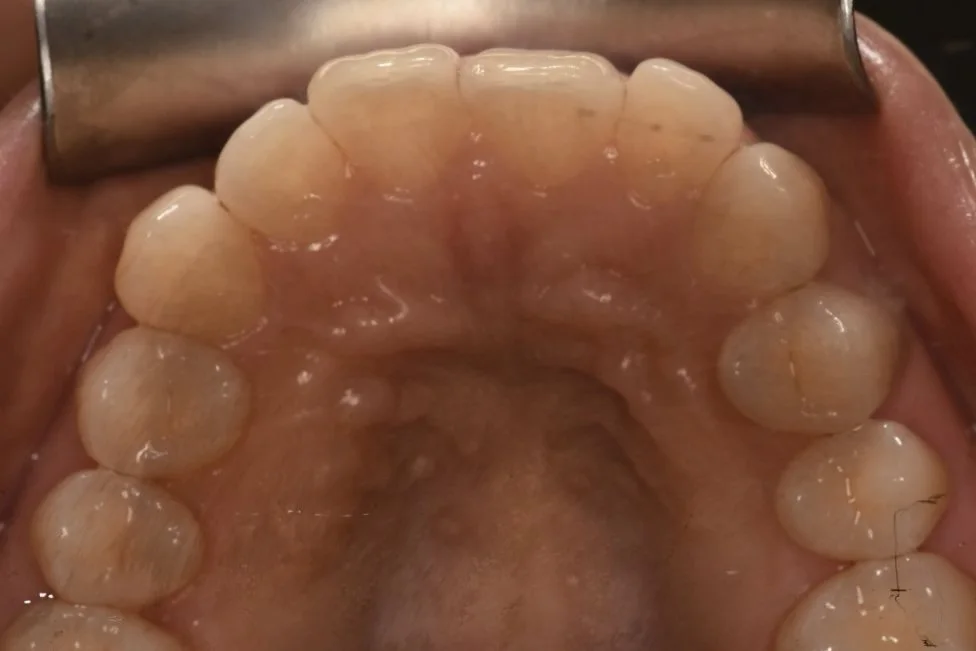 Invisalign before treatment