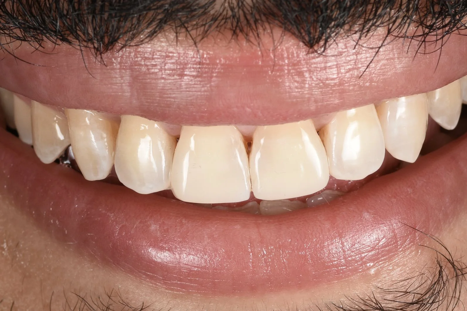 Invisalign & Bonding after treatment