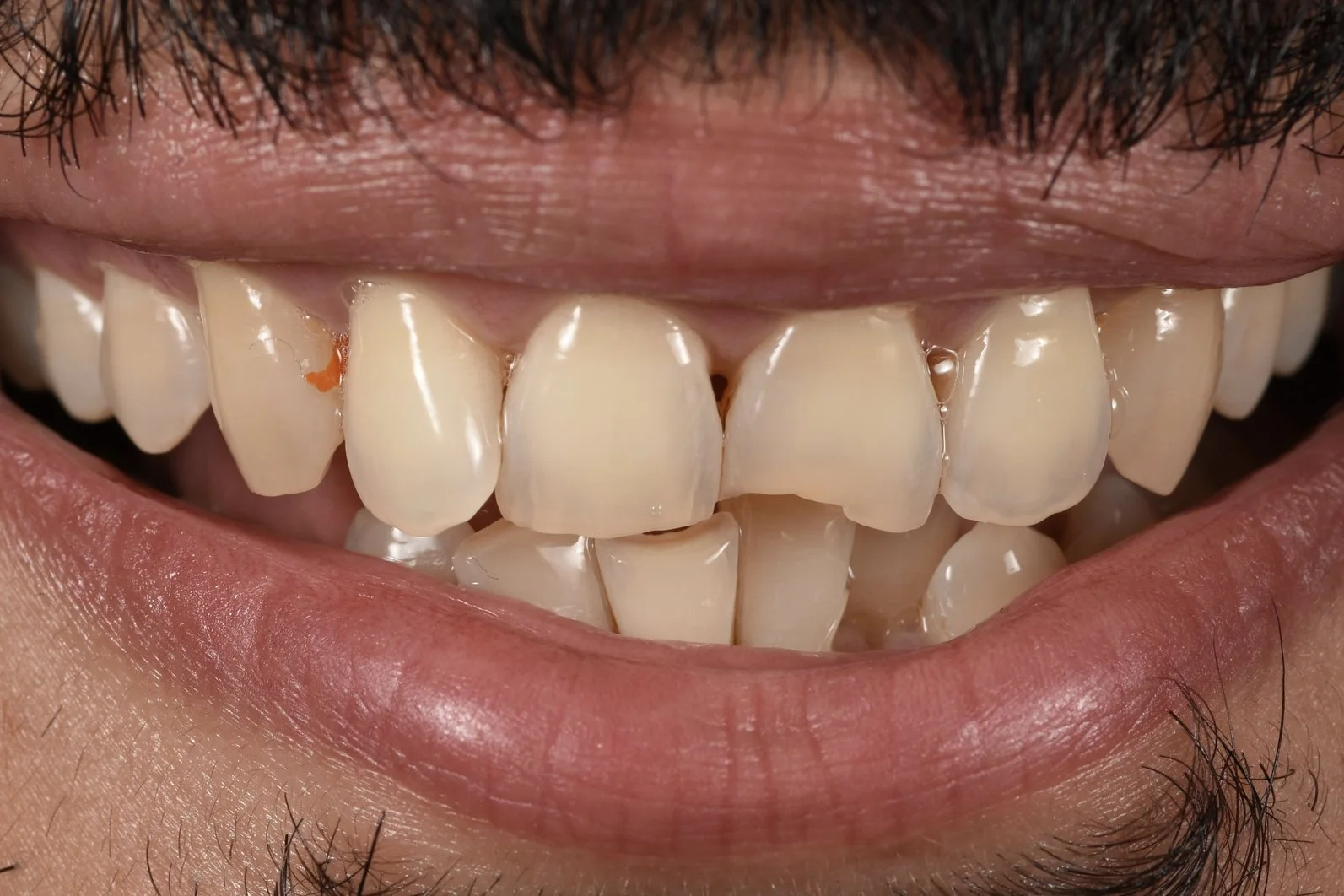 Invisalign & Bonding before treatment