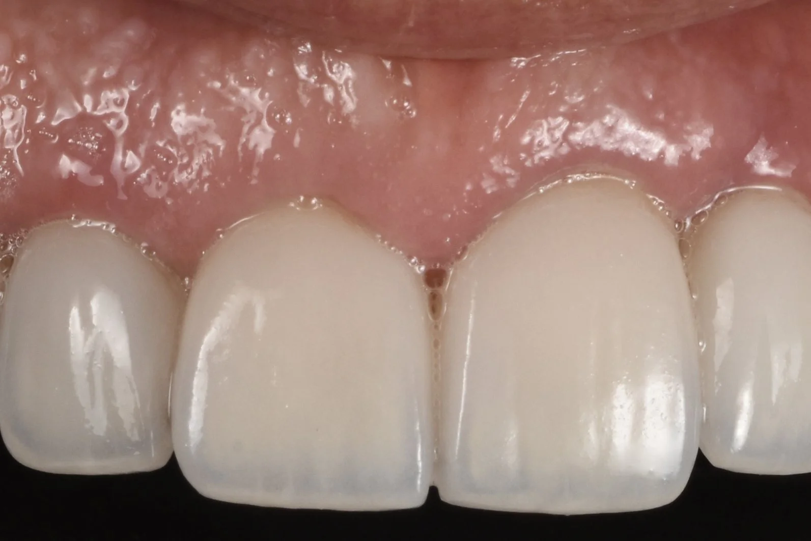 Porcelain Veneers after treatment