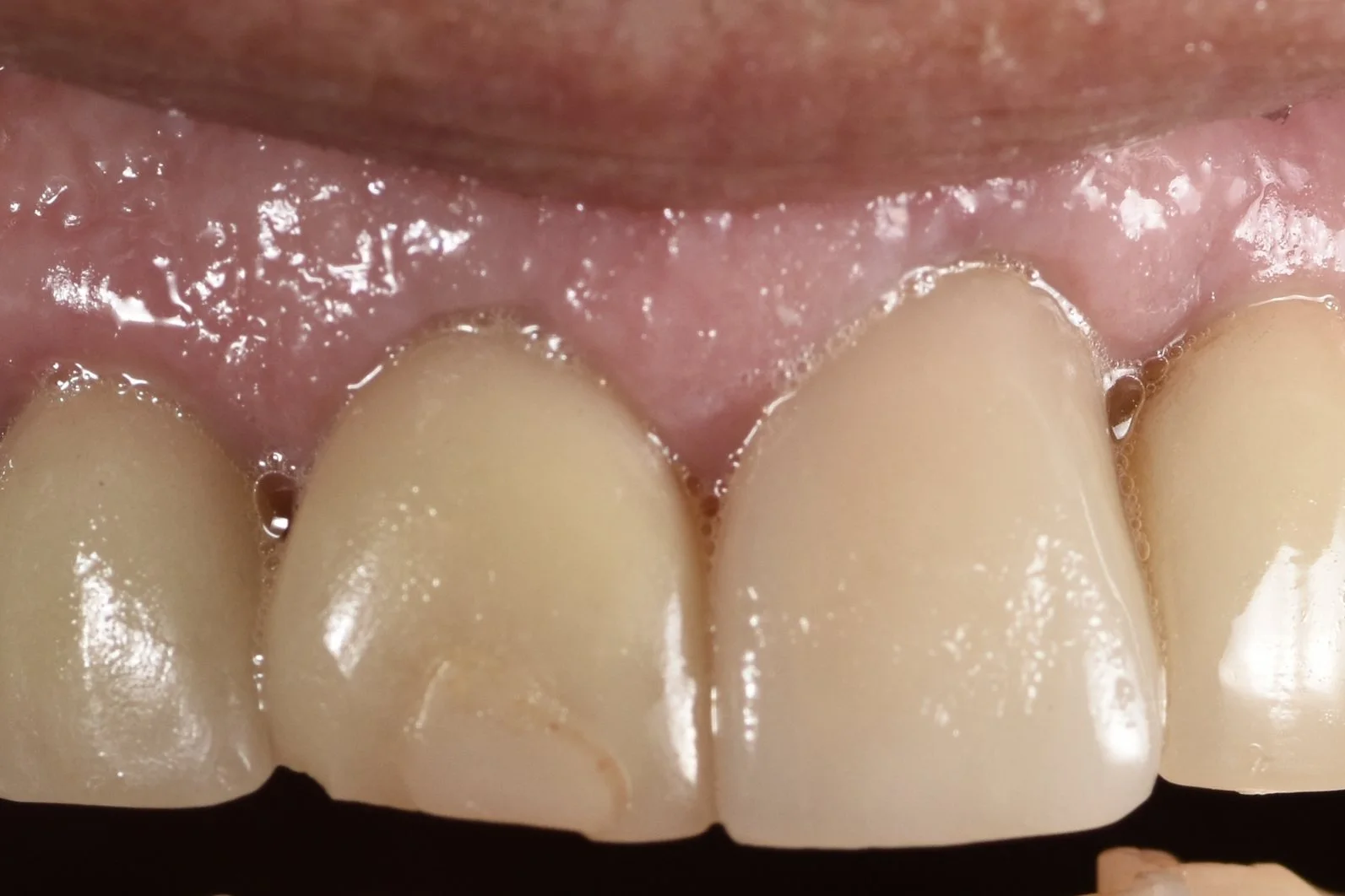 Porcelain Veneers before treatment