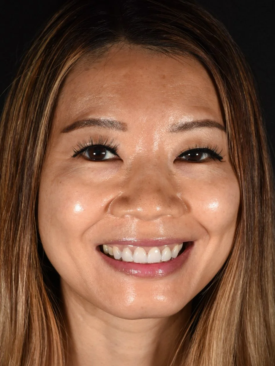 Porcelain Veneers after treatment