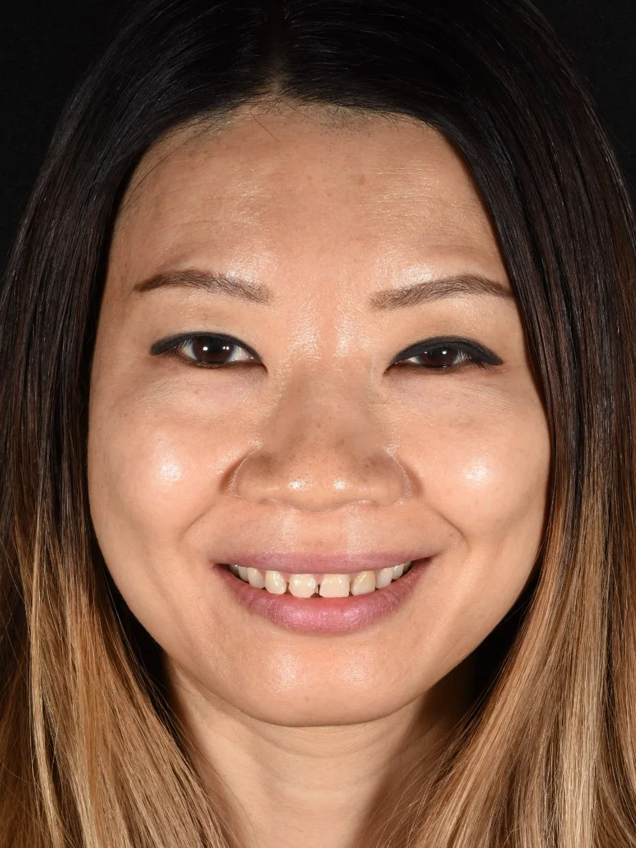 Porcelain Veneers before treatment